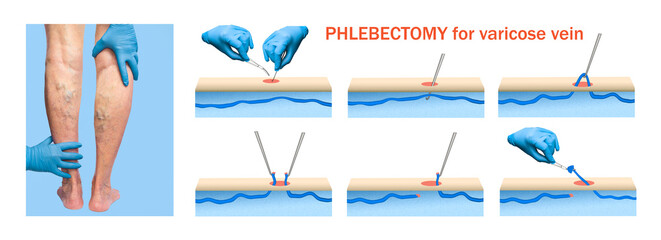 Ambulatory Phlebectomy Treatment for varicose vein.