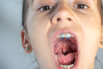 A child girl open her mouth and show her tounge.