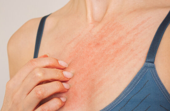 photo of a woman in blue underwear who scratches her breasts and suffers from allergies, itching, skin rash, dermatitis. Allergic reaction. Skin diseases. Healthcare concept