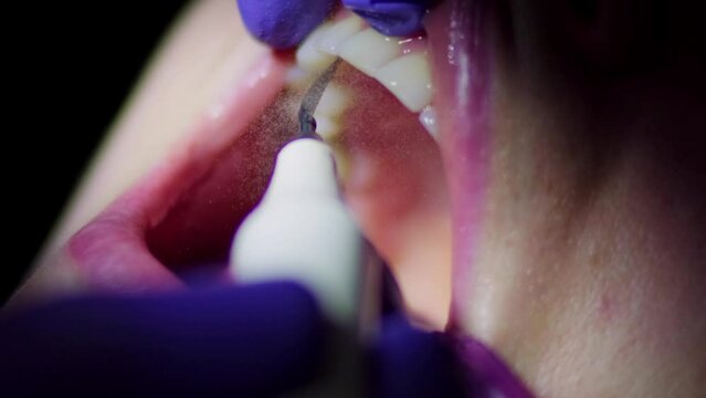 Real footage of a professional dentist cleaning the upper teeth of a woman patient from plaque and calculus with an electric tool using a strong jet of water close-up. Dental care