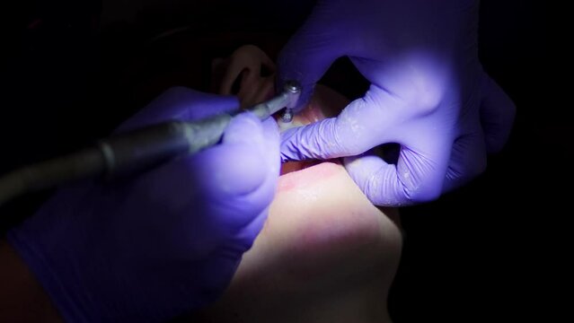 Real footage of a professional dentist whitening the teeth of a female patient from plaque and calculus with an electric tool-pallier close-up. Dental care and whitening