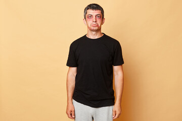 Upset offended injured man in black T-shirt with bruises and abrasions on his face isolated over...