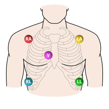 5 Lead Electrode Placement Electrocardiogram - RA, LA, RL, LL, V - Position of ECG 5 Leads - Vector Medical Illustration