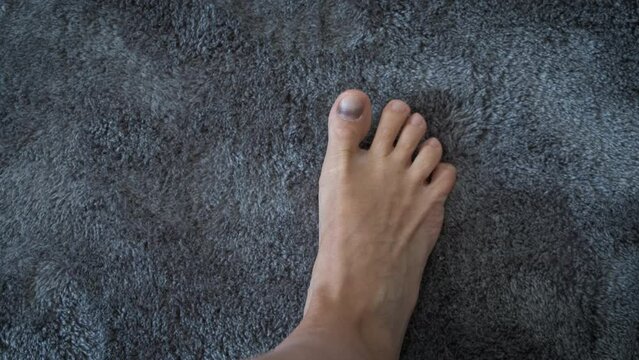 Girl with trauma on toe nail. A view of female bare leg with hematoma under finger nail on the carpet.