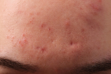 Fototapeta premium Young man with acne problem, closeup view of forehead