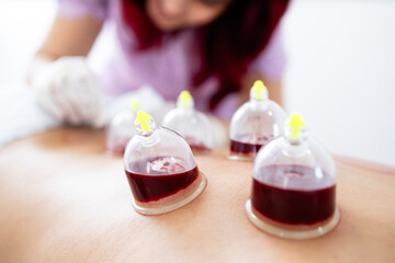 Obraz na płótnie Canvas Alternative medicine for pain relief and relaxation. Professional therapist performing hijama treatment on patient back. Focus on vacuum cups filled with blood.