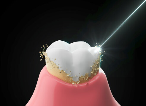scaling teeth, Tartar removal, Oral hygiene and Dental concept, 3d rendering.