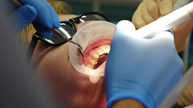 Professional teeth cleaning. Dentist making preventive deep cleaning procedure for teen patient at dental office. Health dental care. Teeth Cleaning Ultrasonic Scaling. Oral hygiene. Dentist removes