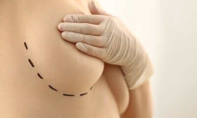 Female breast marked for plastic surgery in clinic. Woman covers bust with hands health and mammoplasty