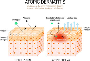 Filaggrin and Atopic dermatitis. eczema - obrazy, fototapety, plakaty
