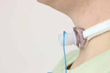 Close up view of a tracheostomy in a adult woman neck. Woman wearing casual clothes with a...