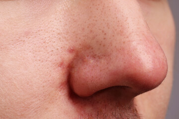 Young man with acne problem, closeup view of nose