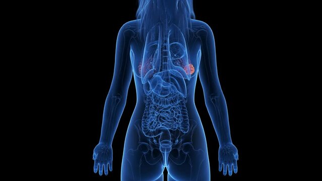 Animation of a cancerous tumor in a woman's breast