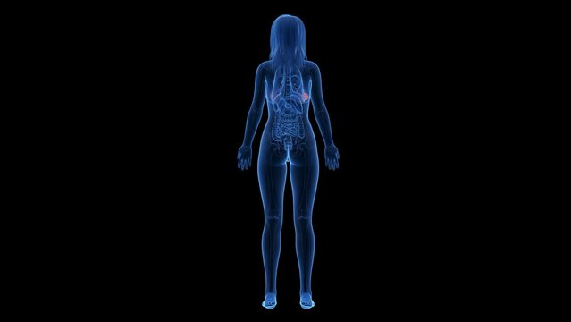 Animation of a cancerous tumor in a woman's breast