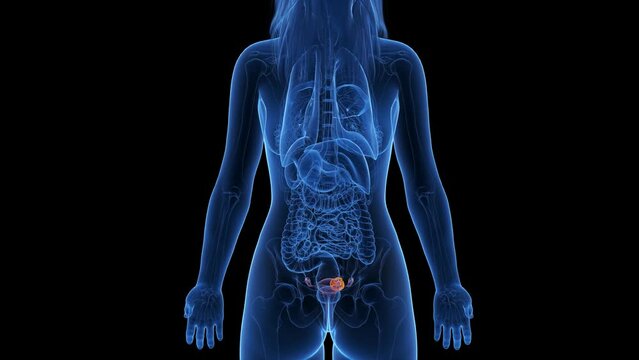 Animation of a cancerous tumor in a woman's uterus