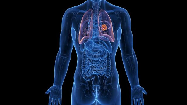 Animation of a malignant tumor in a man's lung