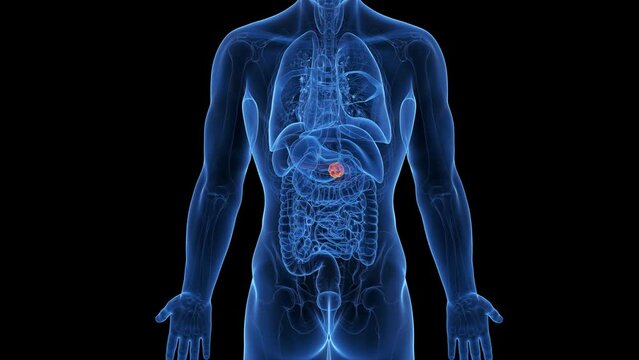 Animation of a malignant tumor in a man's pancreas