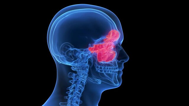 Animation of inflammation of Animation of sinuses