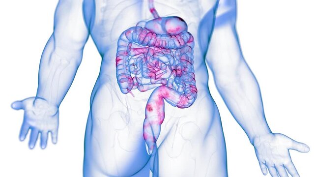 Animation of a colon affected by Crohn's Disease
