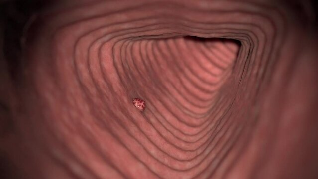 Animation of cancerous tumour growing in large intestine