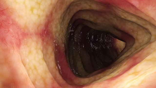 Animation of Crohn's Disease affecting colon