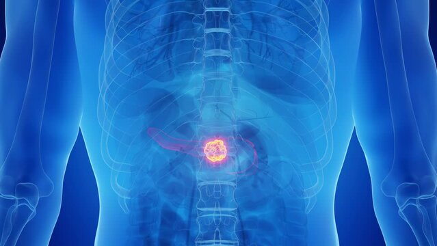 Animation of a malignancy in a man's pancreas