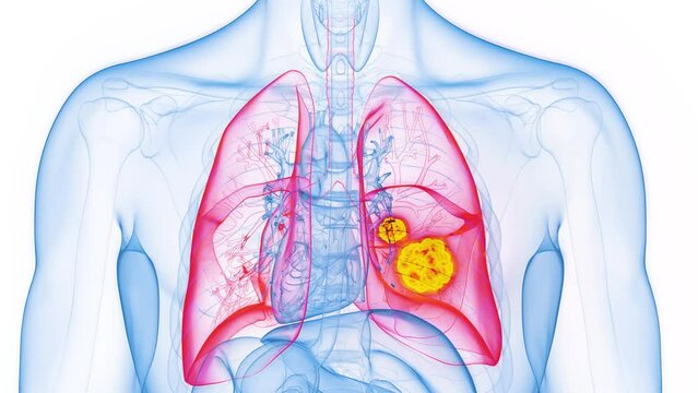 Animation of malignant masses in a man's lung