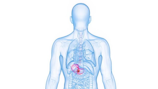 Animation of a neoplastic growth in the stomach of a man