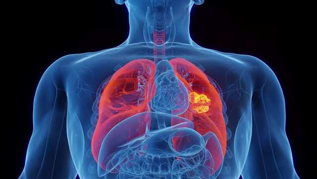 Animation of lung carcinoma in a man's lung