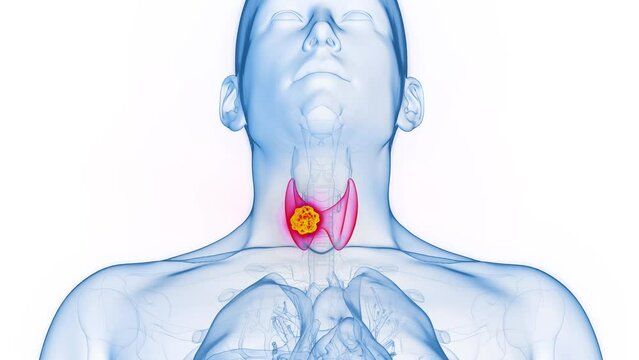 Animation of thyroid cancer in a man's right thyroid lobe