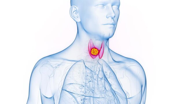 Animation of a malignant tumor in a man's thyroid gland