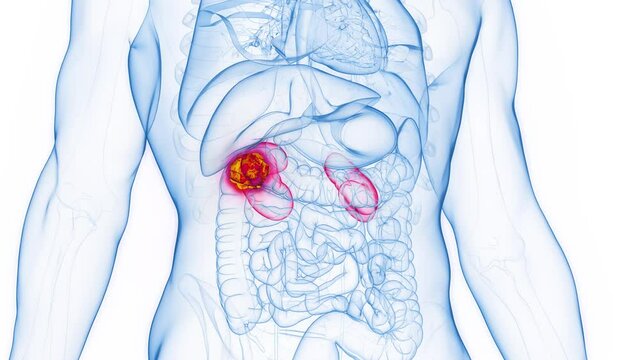 Animation of a malignant tumor in a man's right kidney