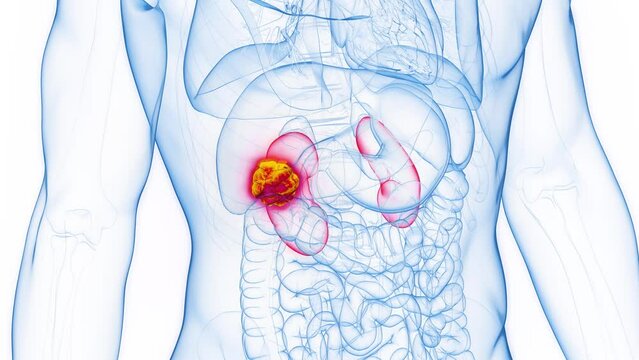 Animation of kidney cancer in a male human