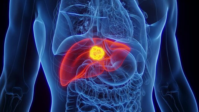 Animation of liver cancer in a male human