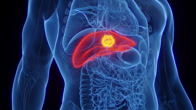 Animation of a cancerous tumor in a man's liver