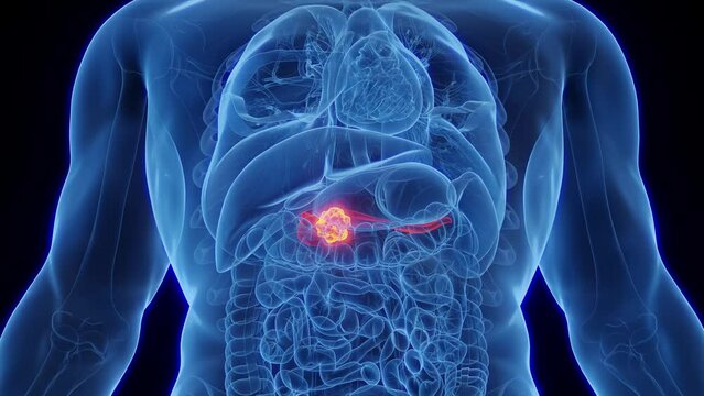 Animation of Pancreatic Cancer