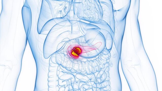 Animation of a malignant mass in a man's pancreas