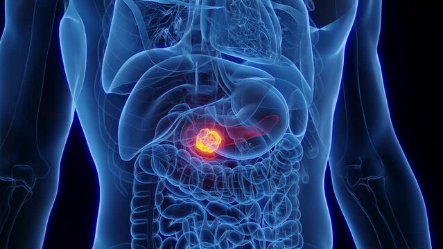 Animation of a malignant growth in a man's pancreas