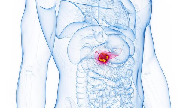 Animation of pancreatic cancer in an adult male human