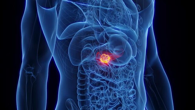 Animation of a cancerous tumor in man's pancreas