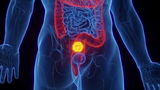 Animation of a cancerous tumor in a man's rectum