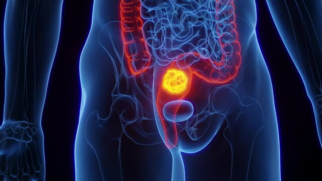 Animation of rectal cancer in a human male