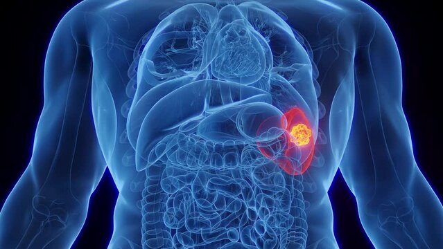 Animation of a malignant growth in a man's spleen