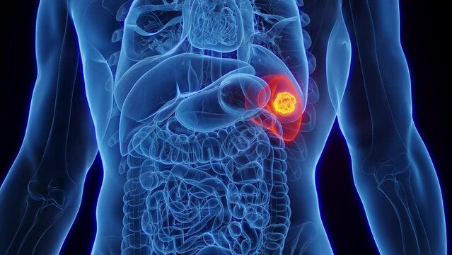 Animation of a malignant tumor in a man's spleen