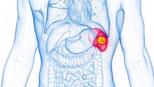 Animation of splenic cancer