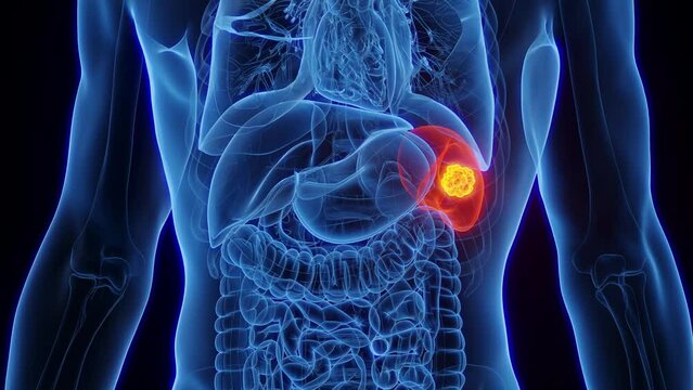 Animation of a neoplasm in a man's spleen