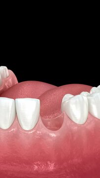Dental implant installation and crown placement. 3d animation