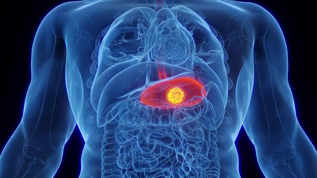 Animation of stomach cancer in an adult male
