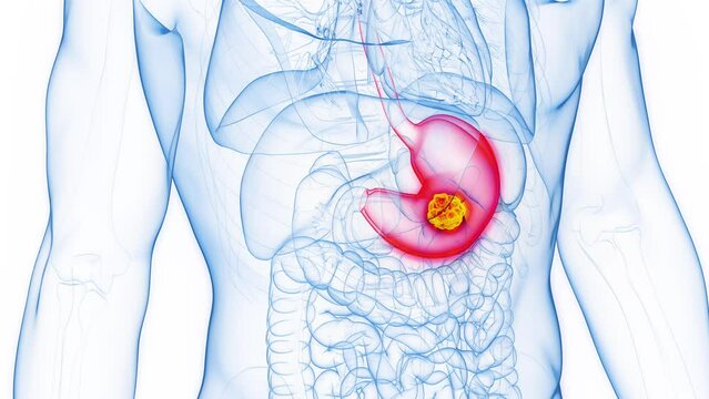 Animation of a malignant tumor in a man's stomach
