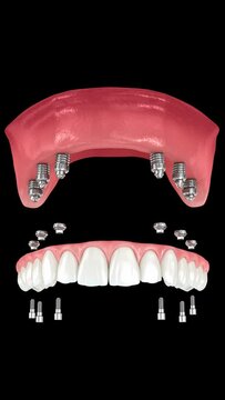 Dental prosthesis based on six implants. Dental 3D animation